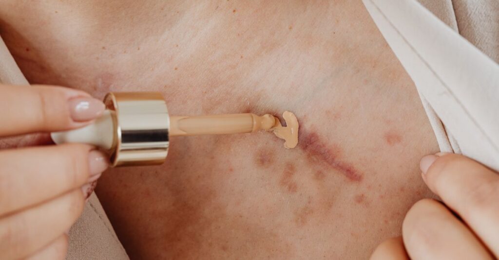皮膚科でのニキビ跡治療に使用されるレーザーやダーマペンの施術イメージ